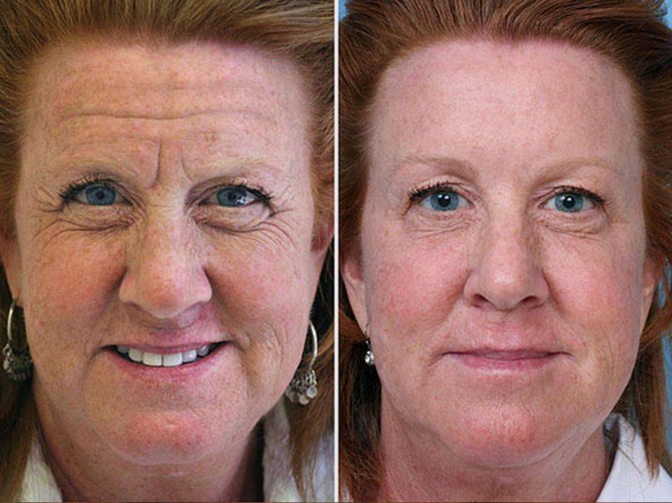 تصویر ـ لیفت پیشانی ـ زن