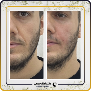 نمونه کار فیلر خط خنده
