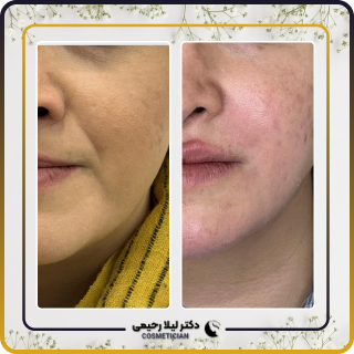 نمونه کار فیلر خط خنده