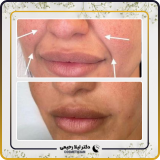 نمونه کار فیلر خط خنده