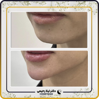 نمونه کار فیلر چانه