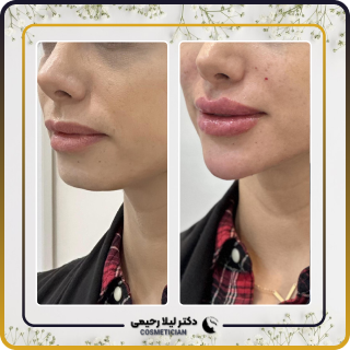 نمونه کار فیلر چانه