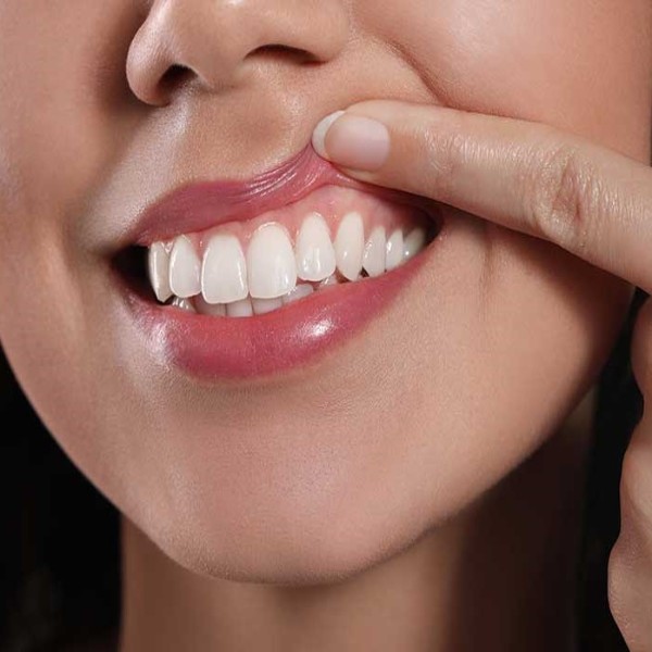 بوتاکس لبخند لثه ای چیست؛ مزایا، عوارض و ماندگاری