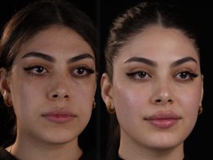 قبل و بعد از تزریق چربی با متد Real Face 
