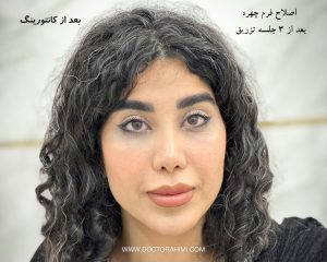 اصلاح فرم چهره بعد از دو جلسه تزریق و اصلاح فرم چهره به شیوه Real Face 