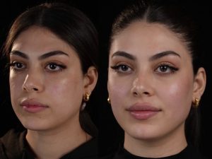 جوانسازی و اصلاح فرم چهره به تزریق چربی در کلینیک دکتر لیلا رحیمی 