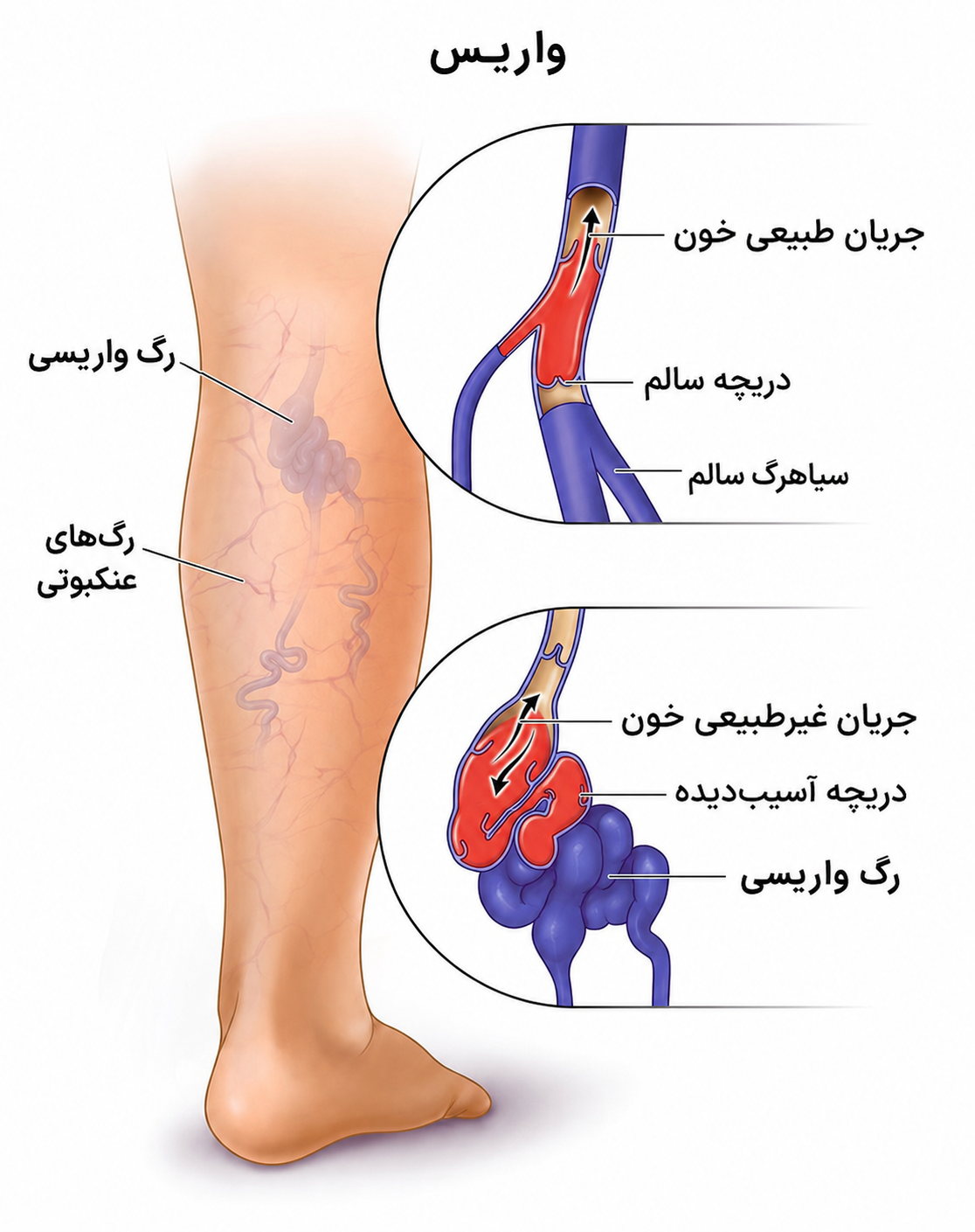 واریس
