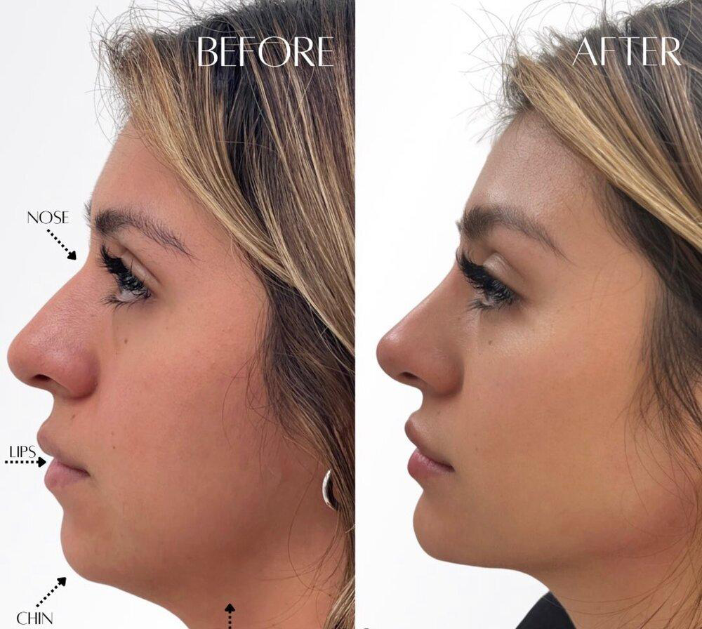 تزریق صحیح فیلر