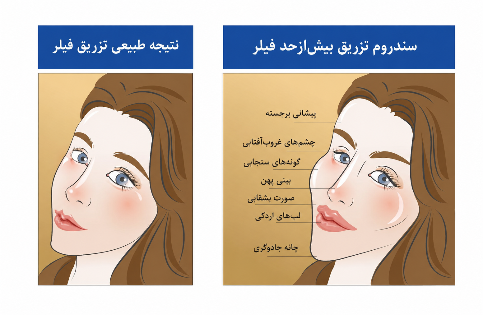 تزریق فیلر بیش از حد