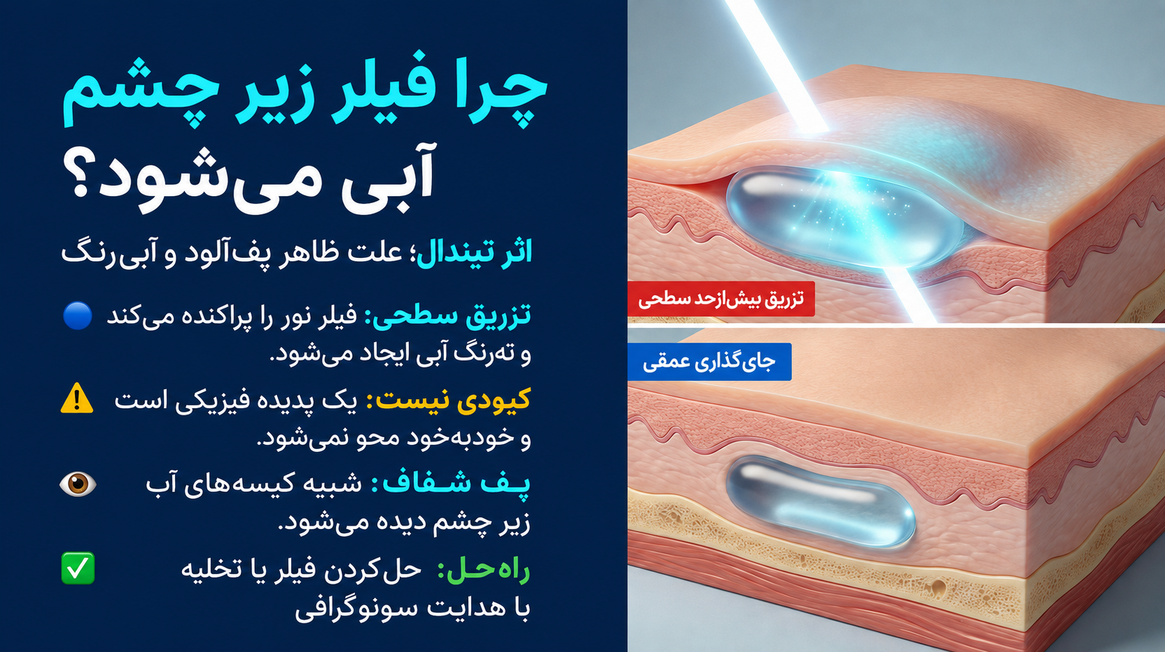 فیلر زیر چشم